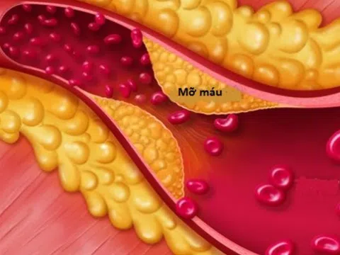 Mỡ máu cao không được chủ quan, kể cả người gầy