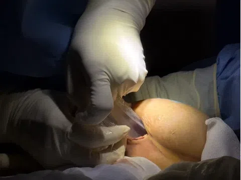 Ám ảnh nâng ngực đau, không dám tháo túi ngực