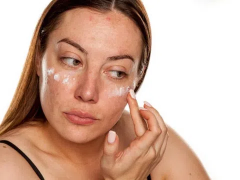 Vì sao nám da dễ tái phát sau khi đã điều trị thành công?