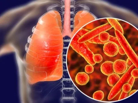 Những dấu hiệu cảnh báo sớm bệnh lao phổi bạn không nên bỏ qua