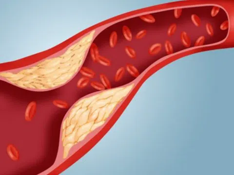 Chỉ số mỡ máu bao nhiêu là nguy hiểm?