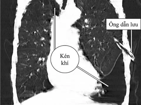 Đột ngột khó thở cảnh giác với kén khí phổi