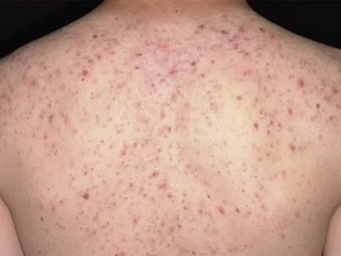 Viêm Nang Lông: Nguyên Nhân, Triệu Chứng & Cách Điều Trị Hiệu Quả