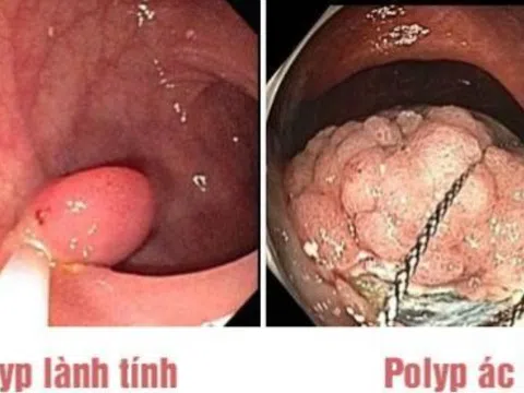 Polyp đại tràng có nguy hiểm không?