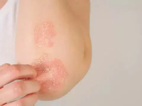 Cần làm gì khi mắc bệnh vảy nến?