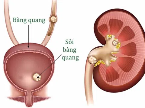 Sỏi bàng quang: Bệnh lý âm thầm dễ gây biến chứng nặng