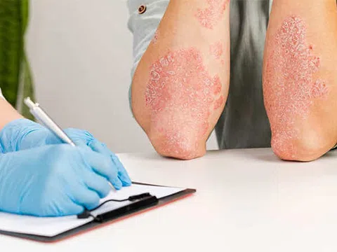 Đi tìm nơi chữa bệnh chàm