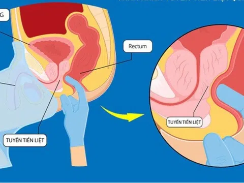 4 biểu hiện của phì đại tuyến tiền liệt nam giới cần biết
