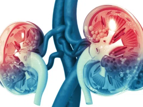 Phát hiện chấn thương thận qua 3 dấu hiệu điển hình