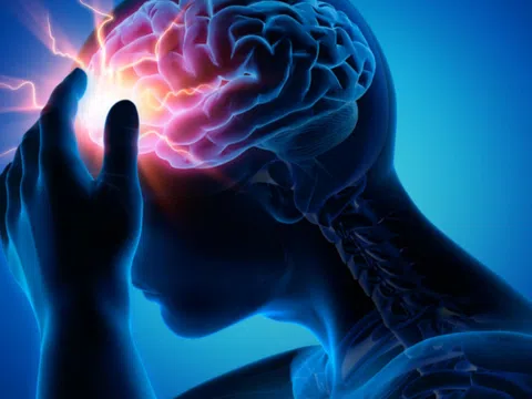 Dị dạng mạch máu não có nguy hiểm không?