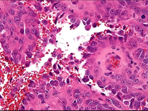 Ung thư nội mô mạch máu ở vị trí hiếm