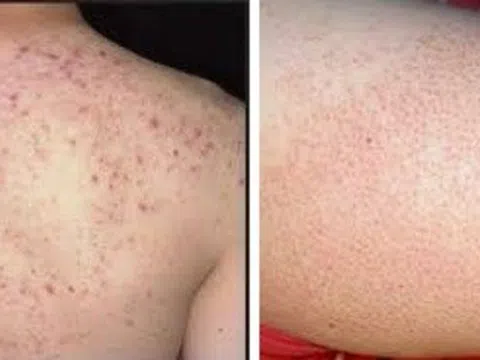 Bệnh viêm nang lông và cách điều trị