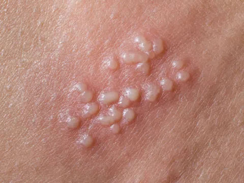 Nguyên nhân gây bệnh mụn rộp sinh dục
