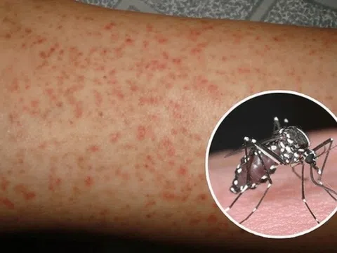 Hà Nội: Sốt xuất huyết đang trong thời kỳ cao điểm