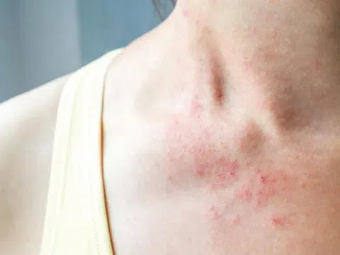 Bảo Thanh Đường - nơi chữa bệnh chàm tận gốc.