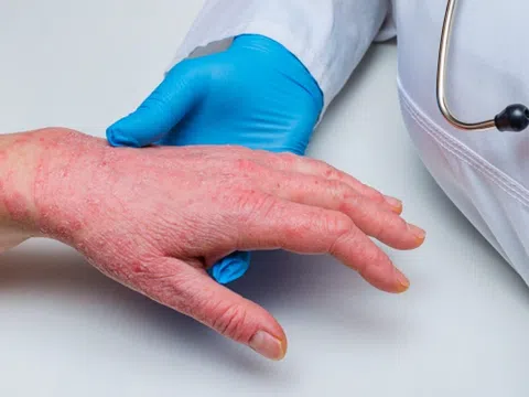 Bệnh viêm da cơ địa tăng nặng khi thời tiết lạnh, khô