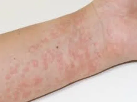 Nổi mề đay sau sinh: Nguyên nhân, Triệu chứng và Giải pháp điều trị