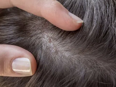 Bảo Thanh Đường - Điều trị dứt điểm bệnh viêm chân tóc