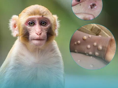 Bệnh nhân đầu tiên mắc đậu mùa khỉ tại Việt Nam là nữ, khởi phát bệnh khi đang đi du lịch