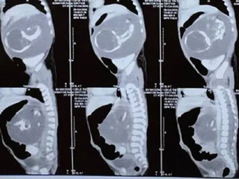 Bé trai chào đời mang theo người em song sinh… trong bụng