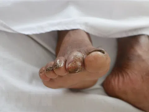 Bệnh Whitmore diễn biến phức tạp, cảnh báo còn gia tăng ở miền Trung