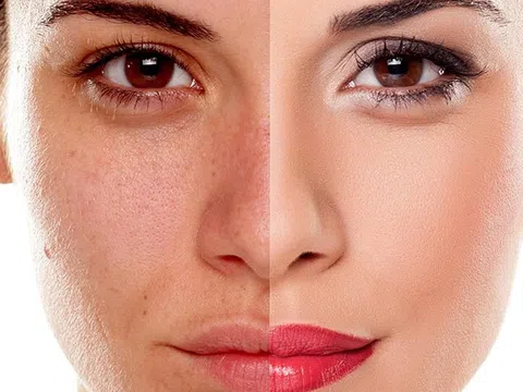 Qua 30 tuổi da xuống cấp nghiêm trọng, đen sạm và nhăn nheo phải làm sao?