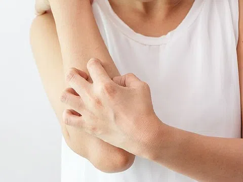 Trời trở lạnh đột ngột dễ gây ngứa ngoài da và nổi mề đay