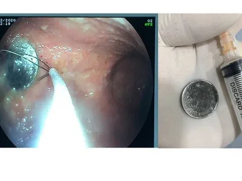 Gắp đồng xu đường kính 2cm trong dạ dày bé gái 4 tuổi