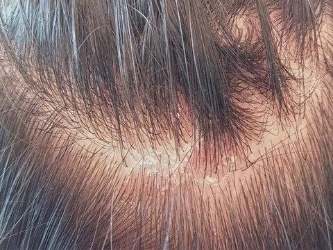 Cảnh báo những tác hại đáng sợ từ gàu? Cách trị gàu dứt điểm và an toàn tại nhà