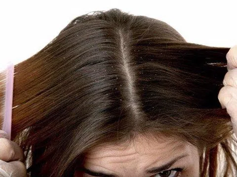 Tại sao dùng dầu gội trị gàu mà không hết gàu?