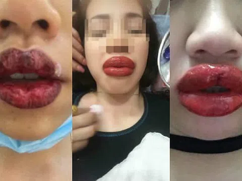 Những điều chị em cần lưu ý trước khi phun xăm môi để tránh rước họa vào thân