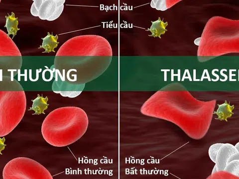 Nguyên nhân và triệu chứng của bệnh tan máu bẩm sinh