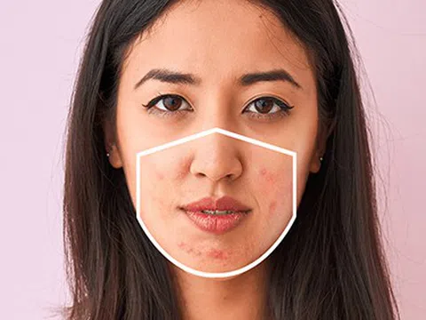 Bật mí bí kíp đeo khẩu trang để giảm mụn cho da nhạy cảm