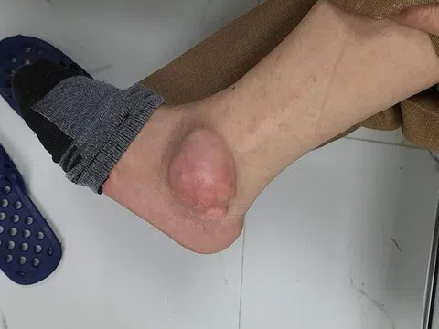 Chân nổi u to như quả ổi vì chữa gout bằng thuốc mua qua mạng