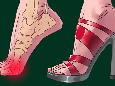 Trợ thủ đắc lực của phái đẹp: Lợi và bất lợi khi mang giày cao gót