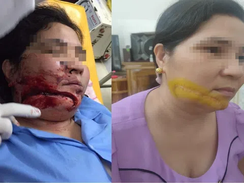 Hàm Yên, Tuyên Quang: Cần làm rõ hành vi kẻ chém người phụ nữ gây thương tích nghiêm trọng, nhưng vẫn nhởn nhơ ngoài vòng pháp luật