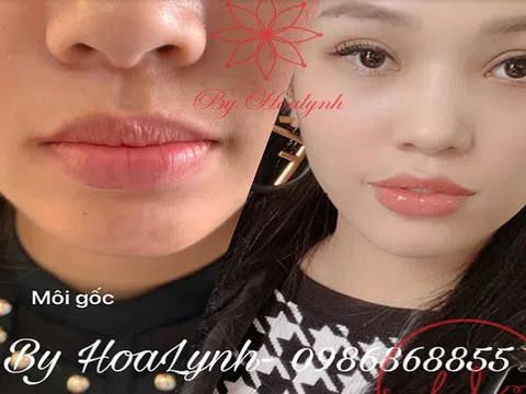 Tiêm filler có ảnh hưởng gì đến sức khỏe không?