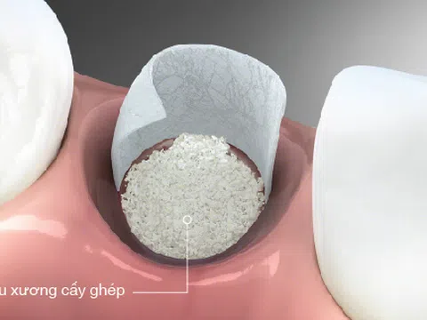 Nha Khoa trồng răng Implant miễn phí cấy ghép xương
