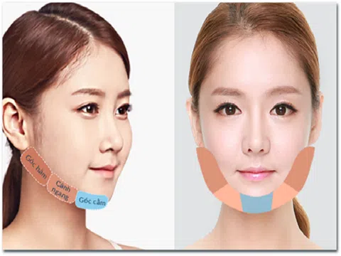 Bí mật đằng sau những ca phẫu thuật gọt hàm làm đẹp