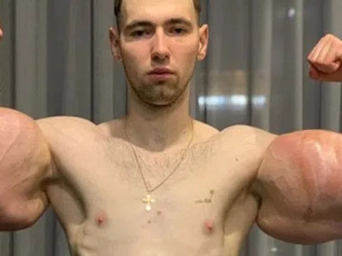 Bơm 3 lít dầu vào tay, thanh niên 23 tuổi bị thối hết cơ bắp