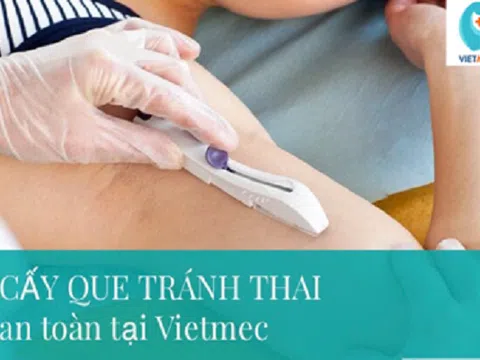 3 vấn đề chị em thường quan tâm về cấy que tránh thai