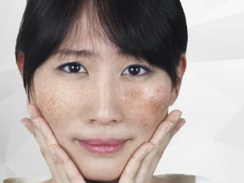 TMV Quốc tế Bắc Mỹ trị nám tận gốc - thổi bay nám và tàn nhang một lần duy nhất