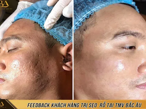 Thẩm mỹ viện Quốc tế Bắc Âu trị sẹo một lần duy nhất