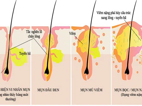 Tổng hợp các loại mụn thường dễ mắc phải