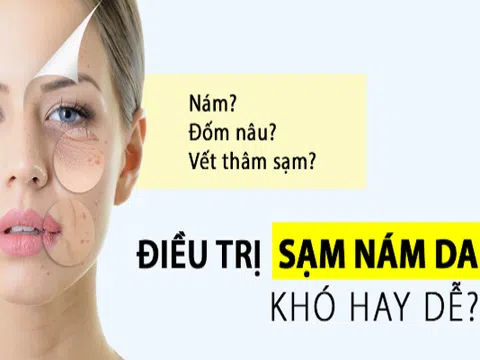 Thẩm mỹ viện quốc tế Bắc Mỹ điều trị nám tàn nhang bẩm sinh an toàn