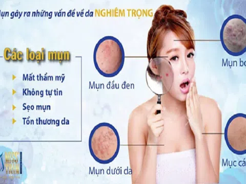 Điều trị mụn bằng công nghệ Laser CO2 Fractional tại TpHCM