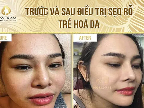 Công nghệ Laser CO2 Fractional chuyên trị Sẹo Rỗ - Rỗ Mụn hiệu quả TpHCM