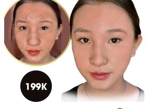 Thẩm mỹ viện Rose trị sẹo hiệu quả 1 lần duy nhất cam kết hiệu quả bằng văn bản