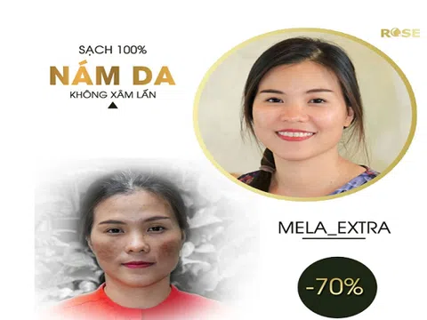 Thẩm mỹ viện Rose Cầu Giấy trị nám 1 lần duy nhất an toàn hiệu quả