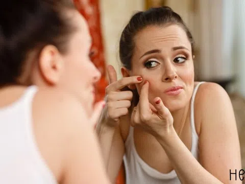 4 điều người bị mụn do nội tiết nên biết